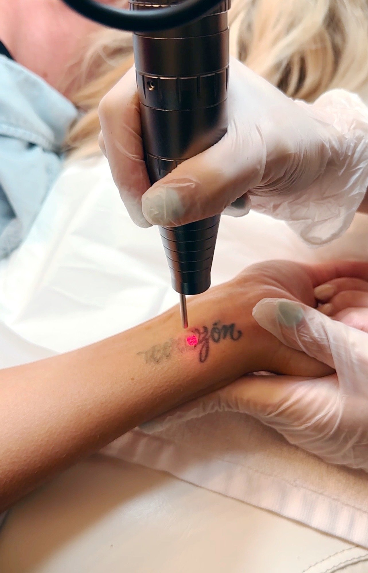 Tattoo Removal Perth | Quality removal of all tattoo types