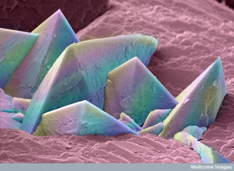 A alimentação e os cálculos renais