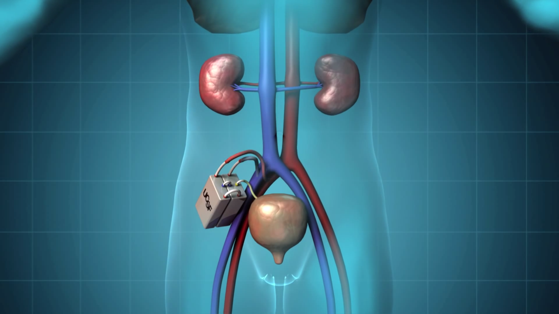 The Kidney Project