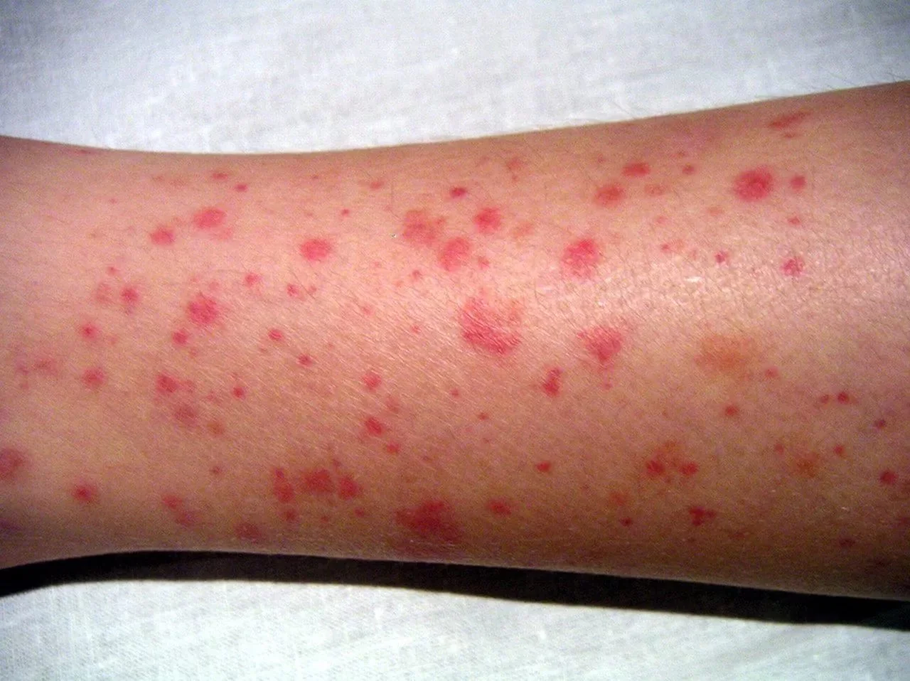 Purpura-Henoch-Schönlein.jpg