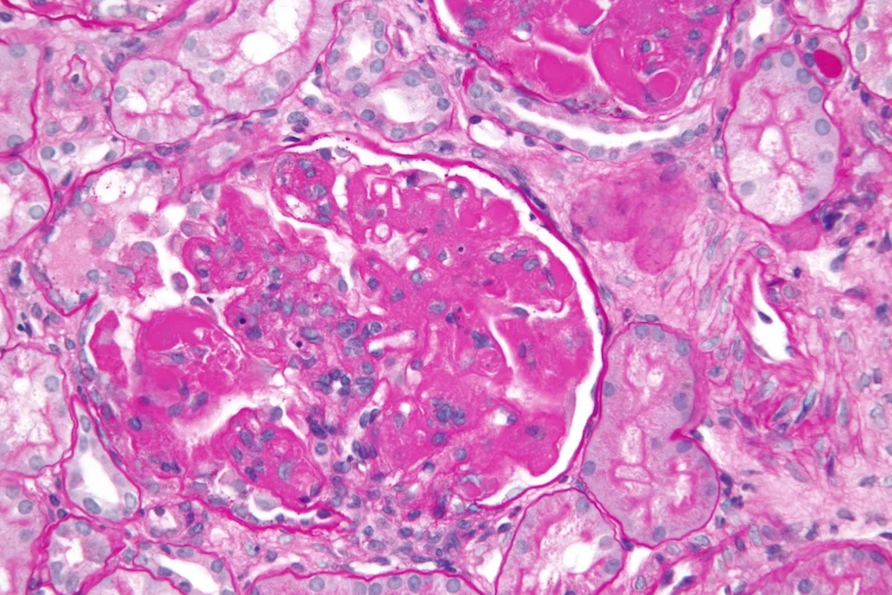 Nefrite-Lúpica-zoom.jpg
