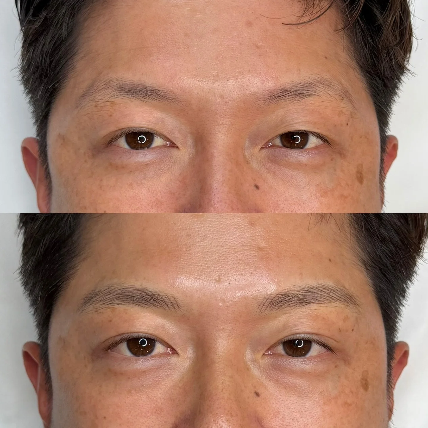 Another set of men's nano feather brows 🤗 Going for a natural and fuller look. Get your brows done before your holiday events and travels! 
&mdash;
Skin type: Combination
Technique: Nano Feather Brows
Pain level: None
Appointment time: 2 hours
Sessi