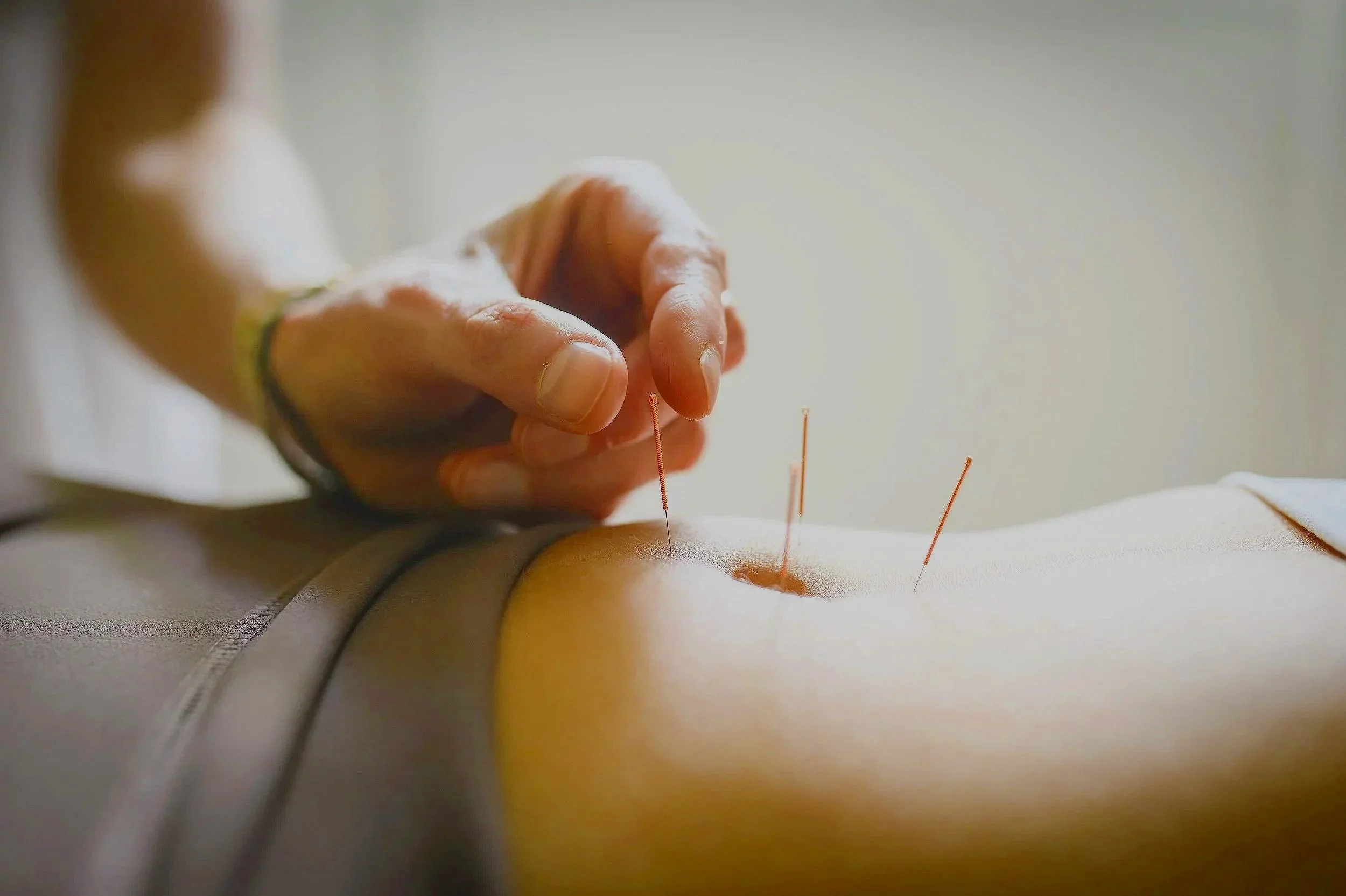 Close up of a bare abdomen and the fertility acupuncture patient is getting four acupuncture needles inserted near the belly button. She is wearing gray lycra pants. The hand of the fertility acupuncturist is also visible inserting one of the needles