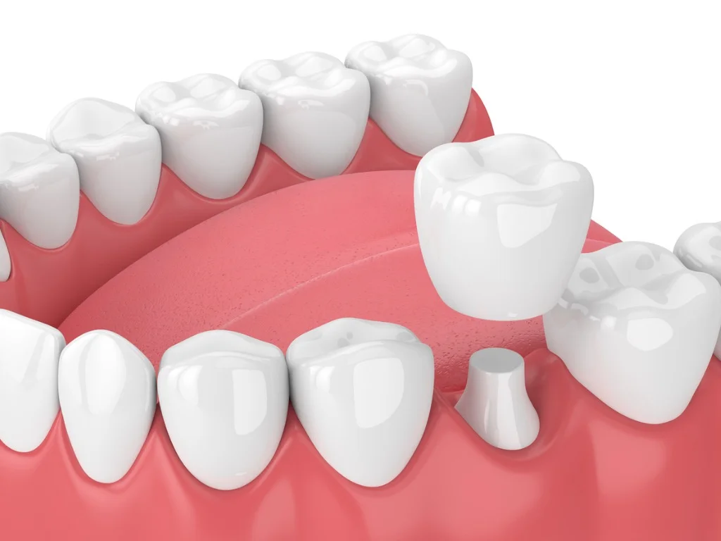 Altona Gate Dental Crown, Bridge Veneer