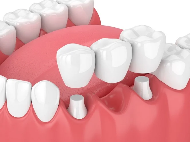 Altona Gate Dental Crown, Bridge, Veneer