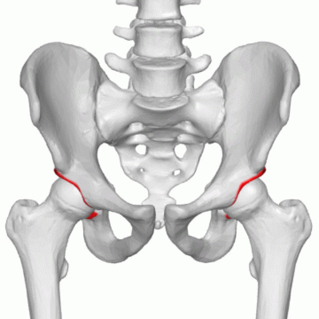 Pedestrian Accident Hip Fracture