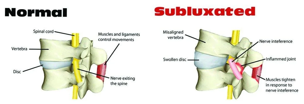 subluxation.jpg