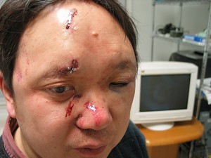 Peter Yuan Li was beaten in his home and had data stolen from his computer by thugs connected to the Chinese Embassy in the U.S.