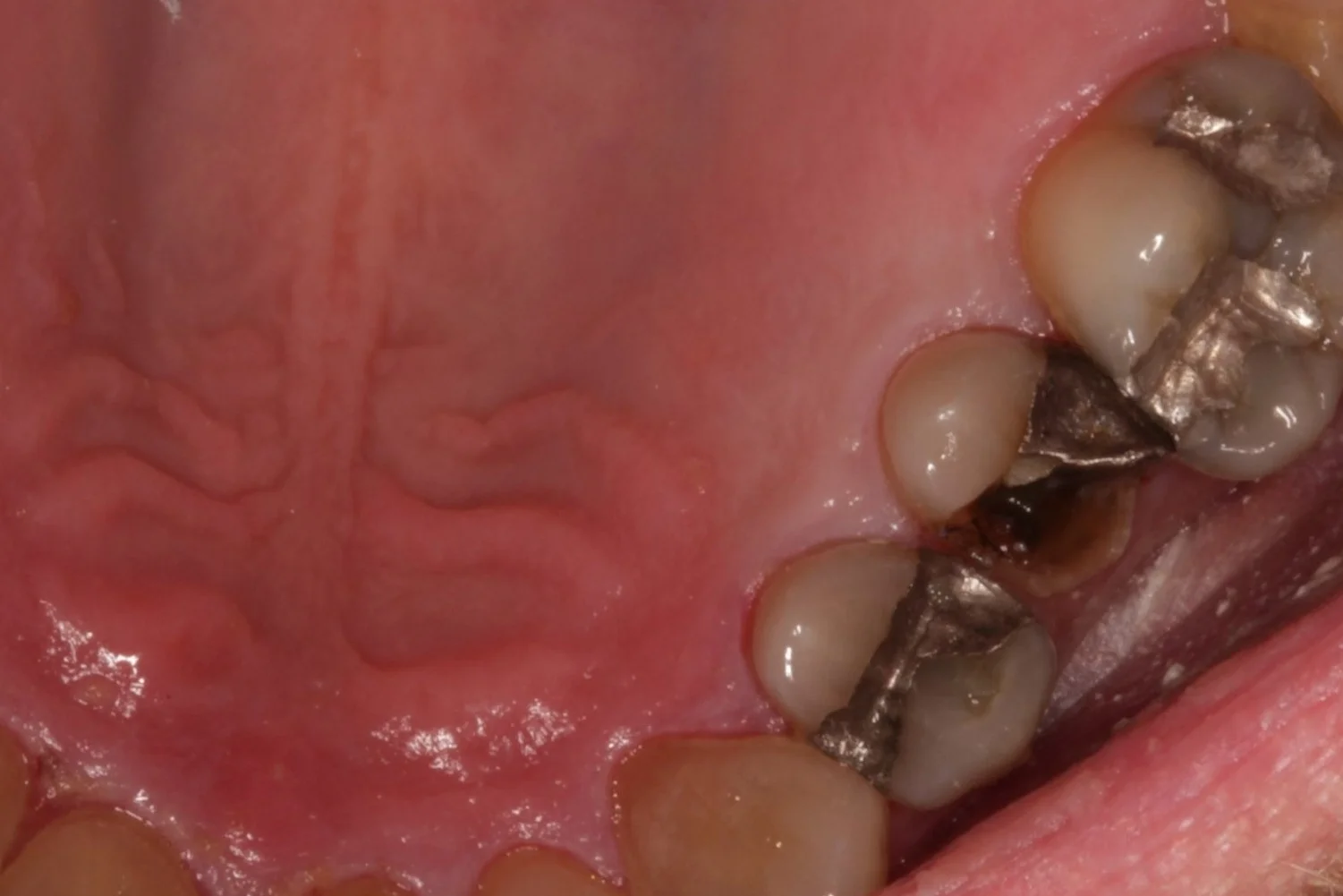 Here is a patient who presented with a fractured premolar.