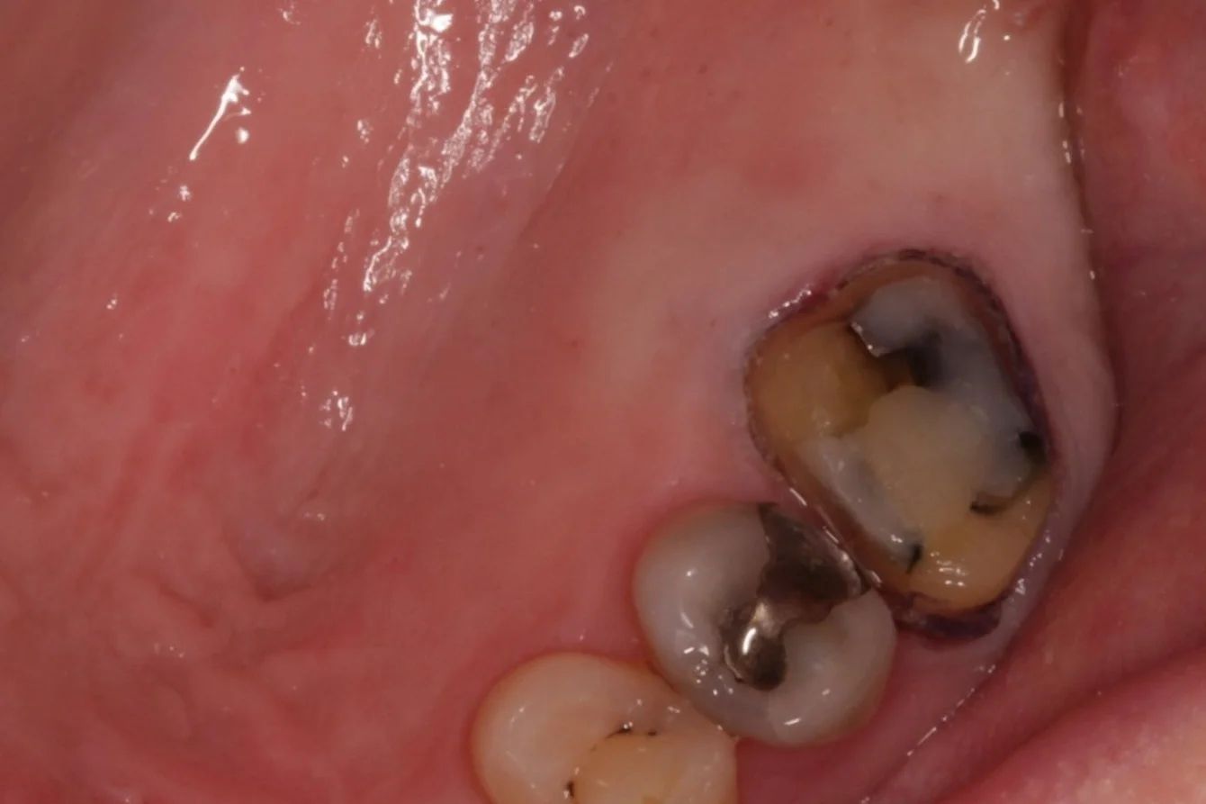 A back molar has been prepared for a crown.