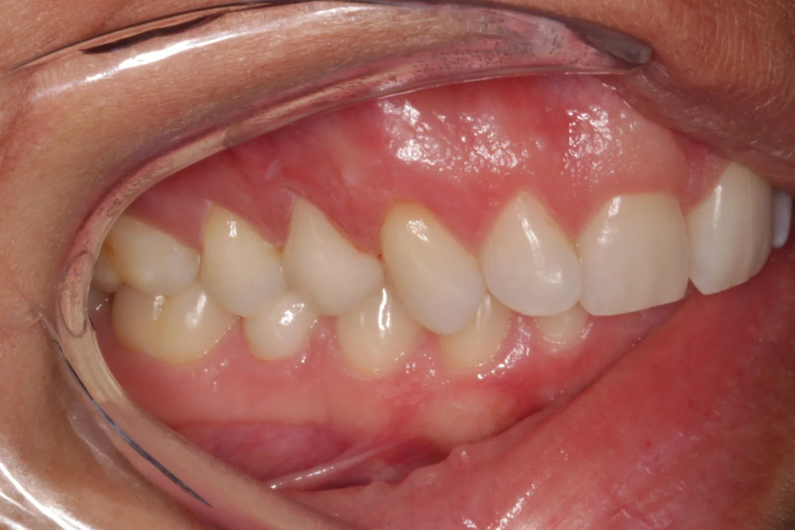 Crowns - What, Why, How