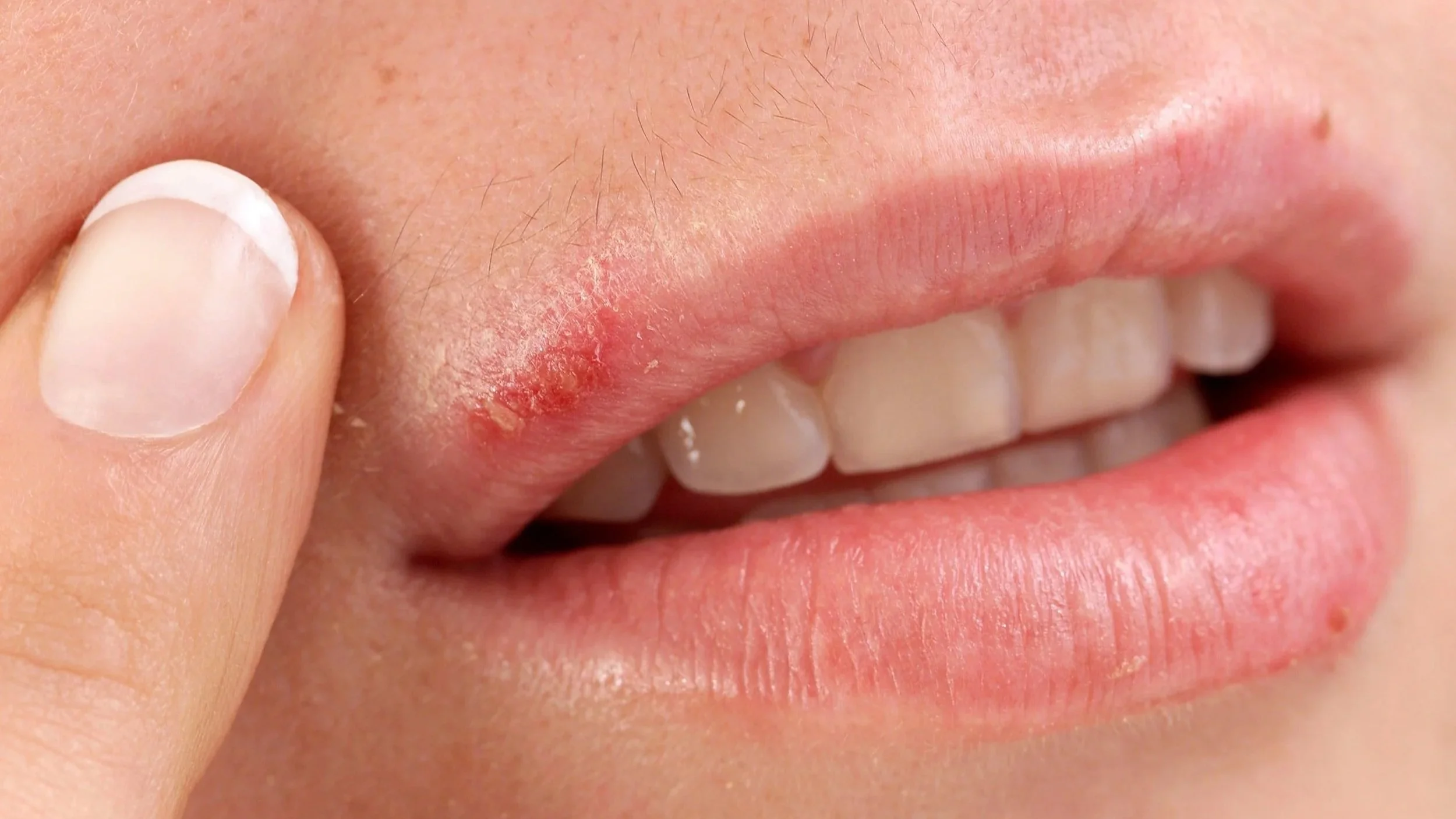 Understanding Cold Sores