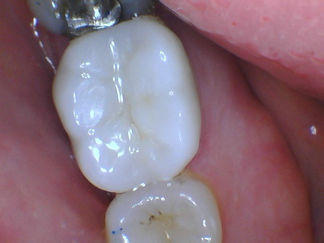 How To Know If You Have A Crack In Your Dental Filling?