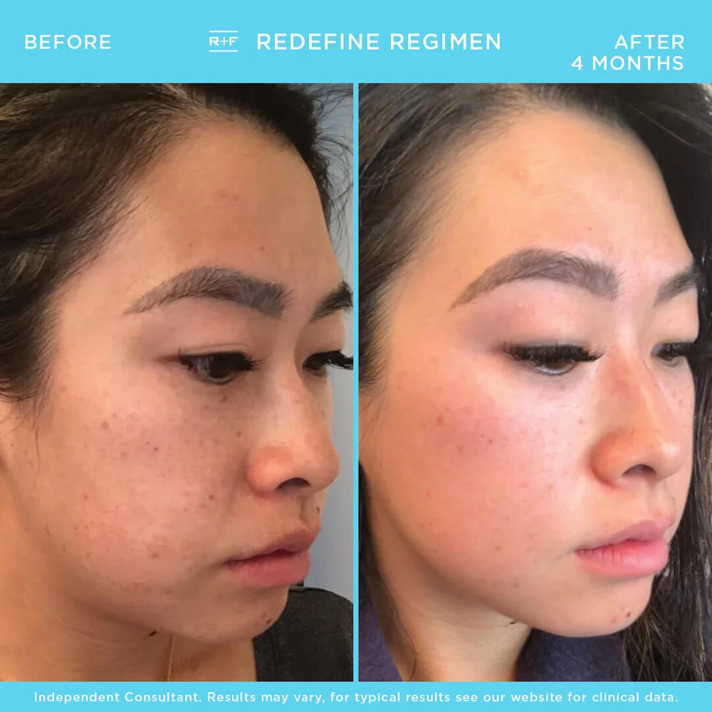 Rodan And Fields ロダンアンドフィールズ プロアクティブを始めた女性皮膚科医がこだわった処方箋ギリギリ 結果重視のスキンケアライン バンビまつ毛美容液も 全米ナンバーワン売り上げ Kikidune