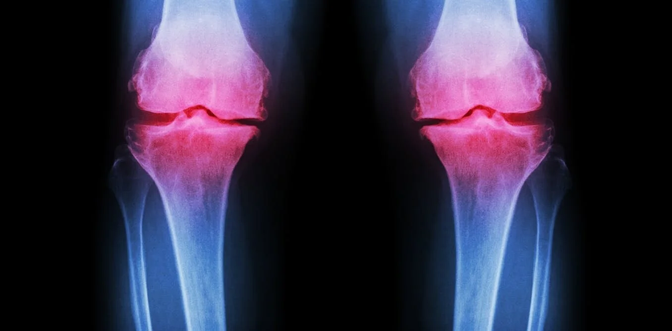 Senior Health Myth: Osteoarthritis and Exercise