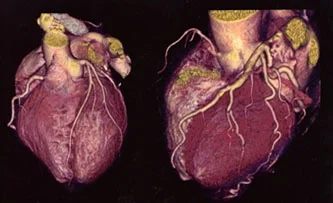 CORONARY CT ANGIOGRAM (CCTA)