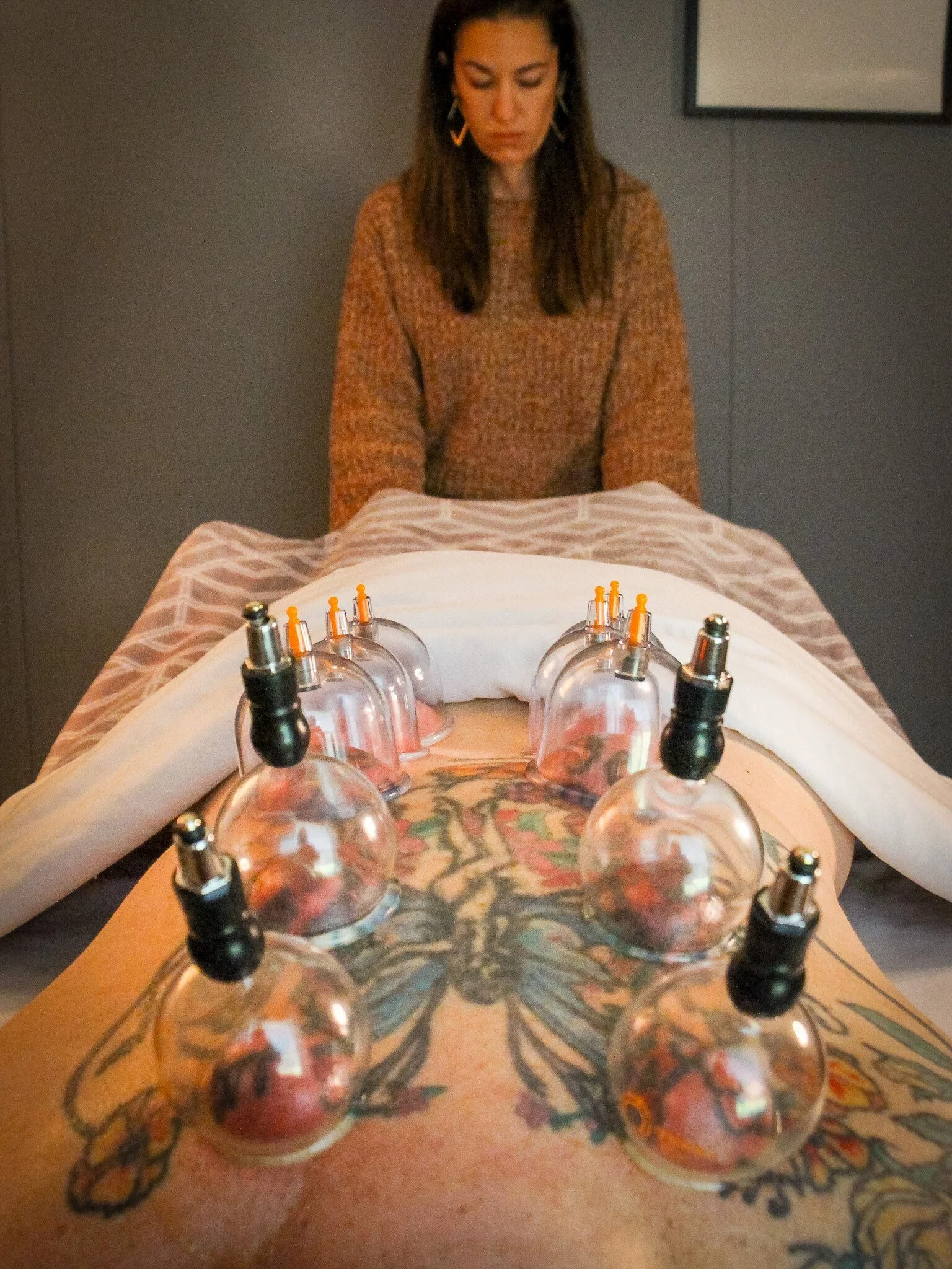 A picture of cupping therapy at Revive Acupuncture and Wellness in Berwick, ME