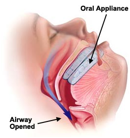 sleep_apnea page image 4.png