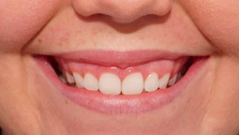 Flagstaff-Gummy-Smile-Reduction-2.jpg