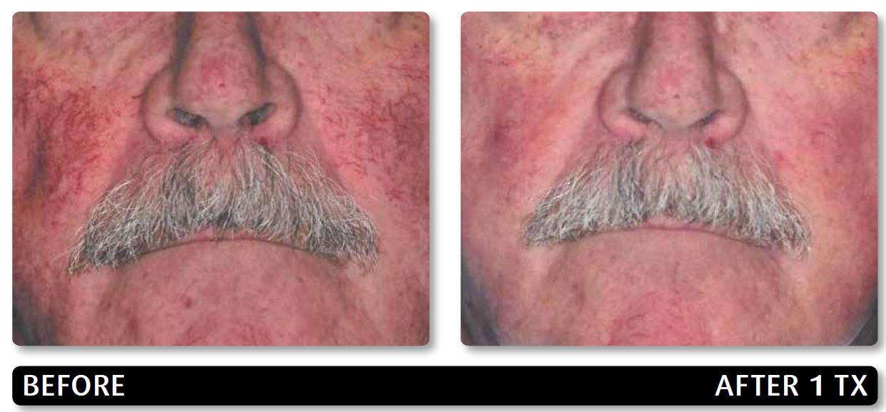 IPL pigmentation reduction.JPG