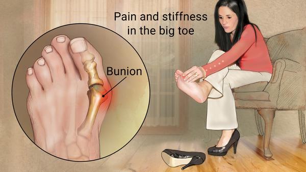 Bunions.jpg