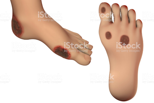 ulcerz.png