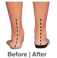 orthotics 2.jpg