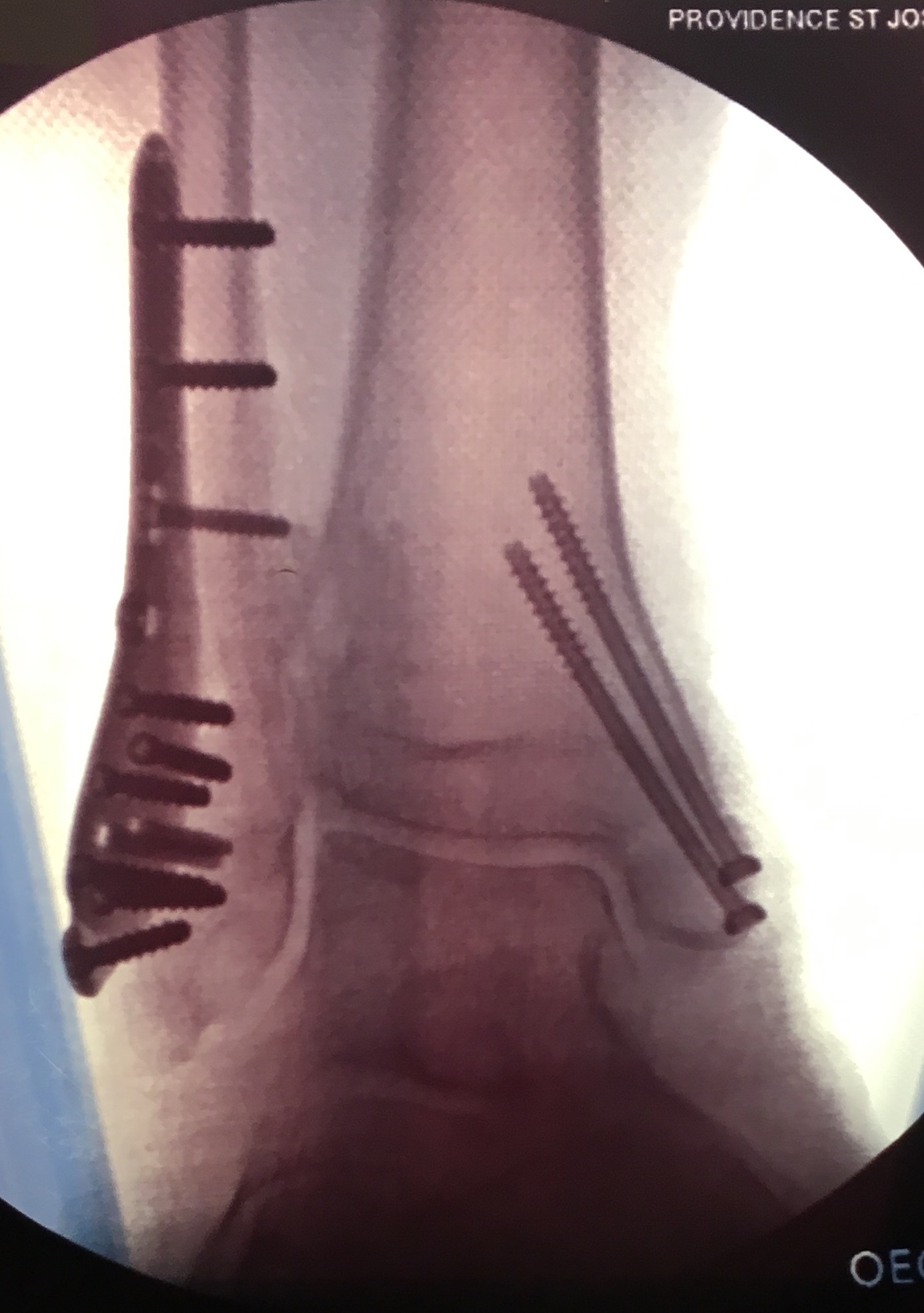 Bimalleolar ankle fracture with open reduction and internal fixation