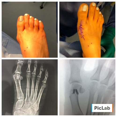 4 weeks status post bunionectomy performed by Dr. Levine