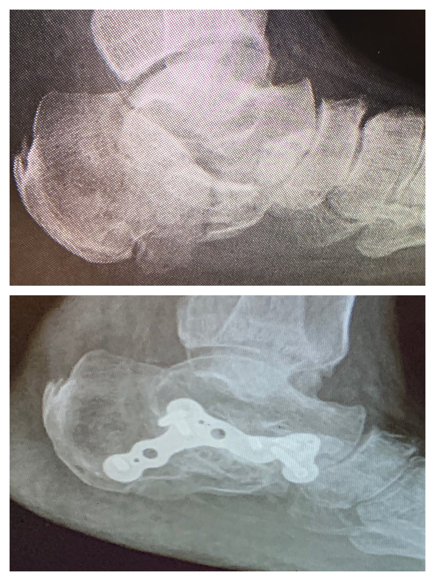 Uncontrolled type II diabetic 4 months status-post ORIF of severely comminuted calcaneal fracture. The patient is now walking with no pain