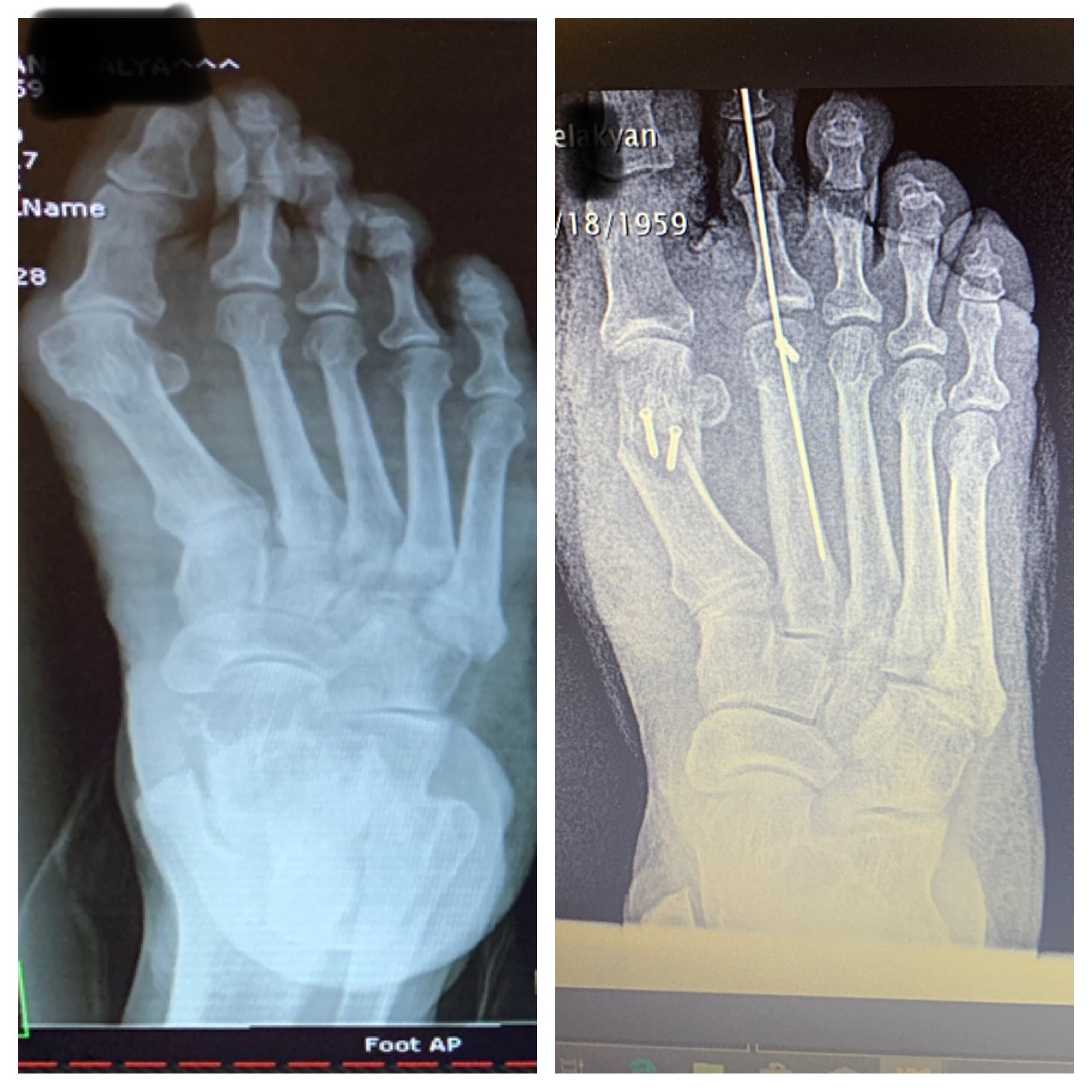 Status-post bunion and hammertoe repair