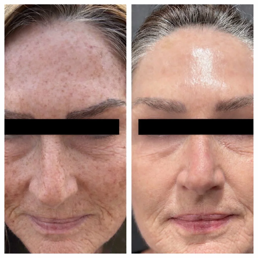 One treatment. Real transformation. ✨

IPL targets sun damage, redness, brown spots, and visible capillaries while also stimulating collagen to soften fine lines, wrinkles, and improve overall skin texture.

The before photo was taken just one day af