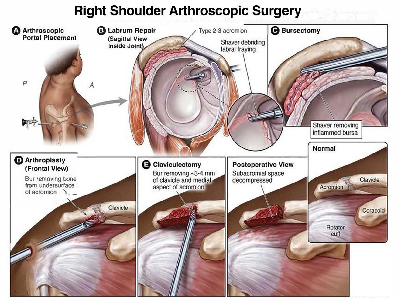 Arthroscopic Rotator Cuff Repair, Orthopedic Shoulder Surgeon