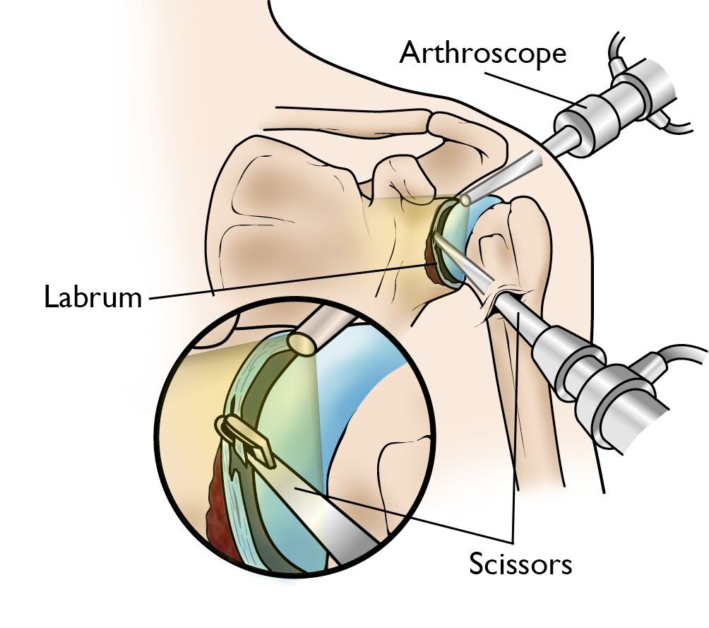 Shoulder Arthroscopy Louisville Lexington Aptiva Health shoulder-arthroscopy-louisville-lexington-aptiva-health