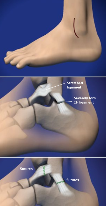 Ankle Injuries Treatment