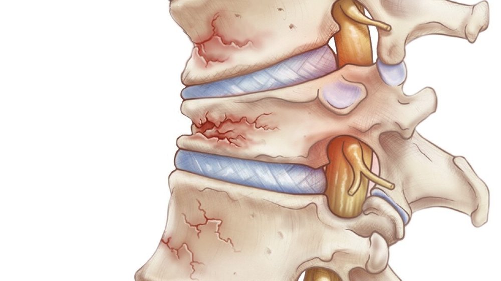 Back Pain Treatment in Kentucky & Indiana | Aptiva Health