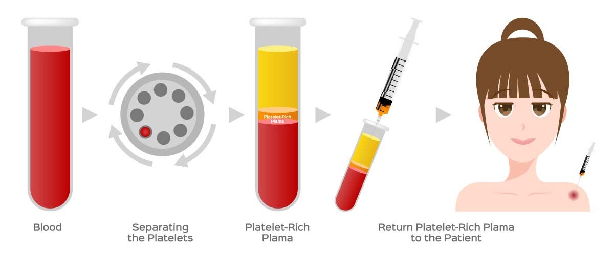 Platelet-Rich Plasma (PRP) Injection: How It Works