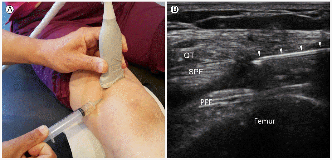 Us Guided Gh Inj Joint Injections | Aptiva Health