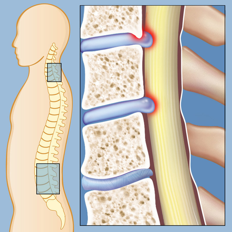 Spinal Stenosis Causes, Symptoms & Treatment