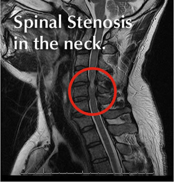 https://images.squarespace-cdn.com/content/v1/5b58b1cef8370aa14856d69c/1624474653870-1QMQ2B3JUGAPPUB8BQWK/cervical-spinal-stenosis.jpg