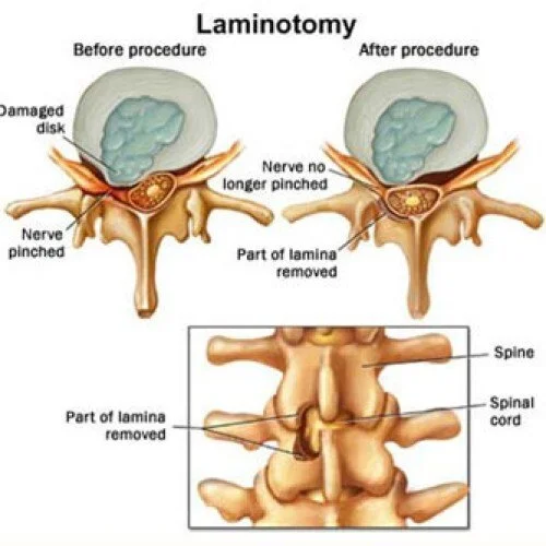 Spinous Process Spliting Spinal Stenosis: Treatment & Relief | Aptiva Health