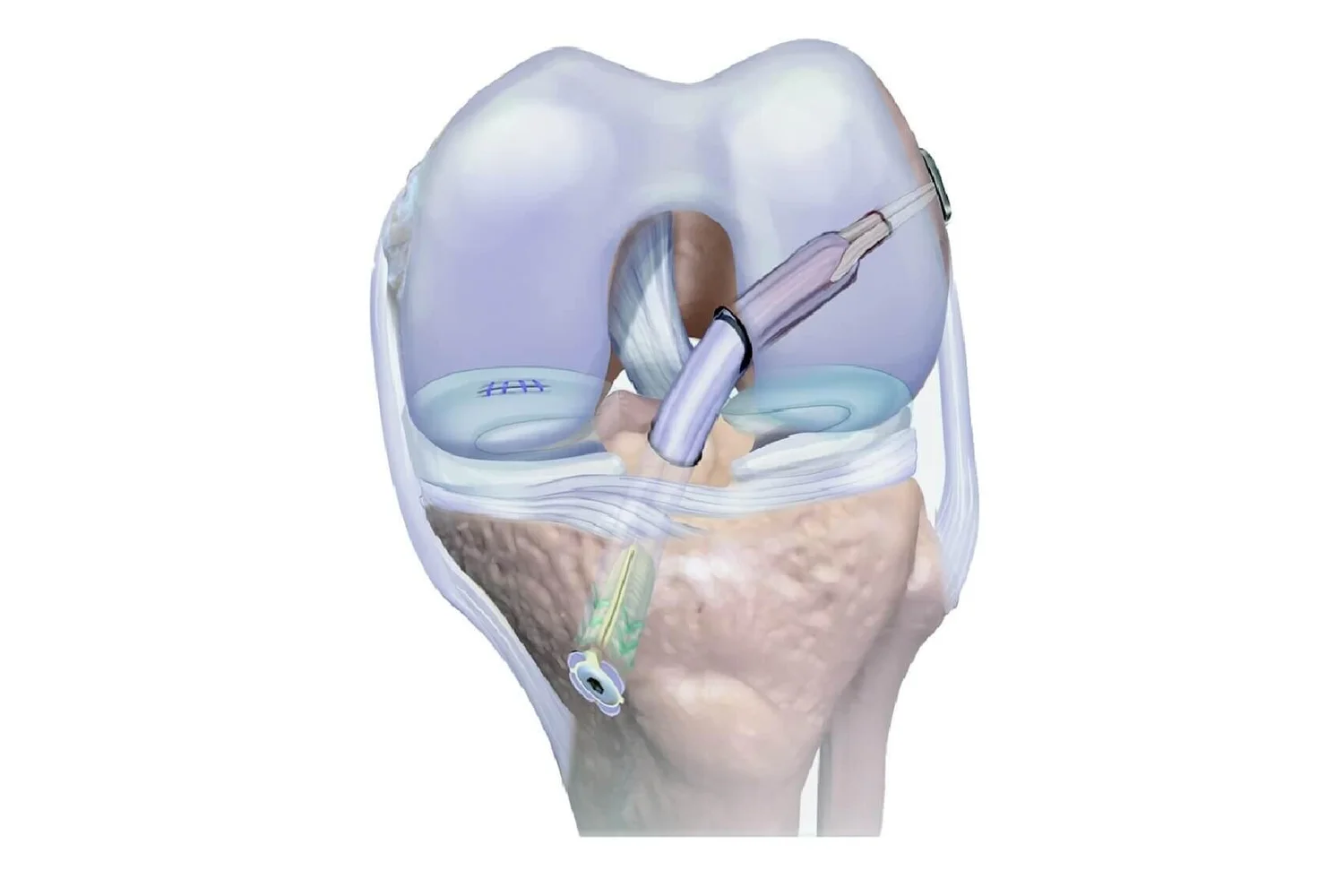 ACL Surgery Options | Aptiva Health