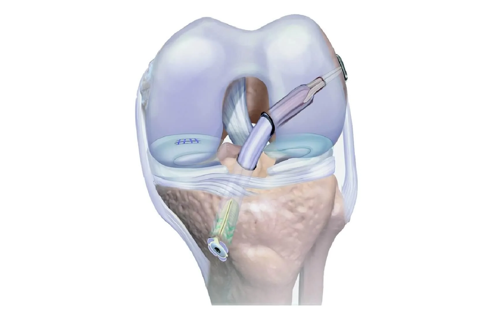 ACL Surgery Options Aptiva Health