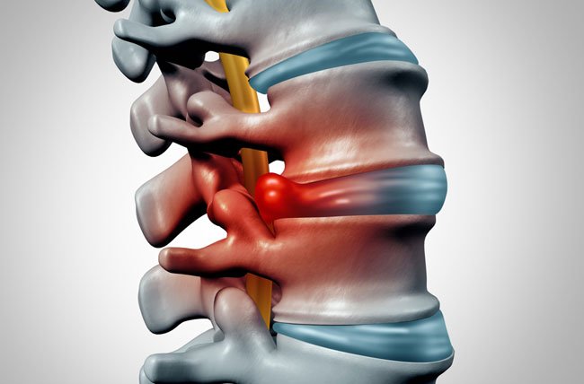 Disc Herniation