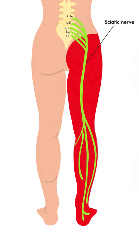 Sciatica