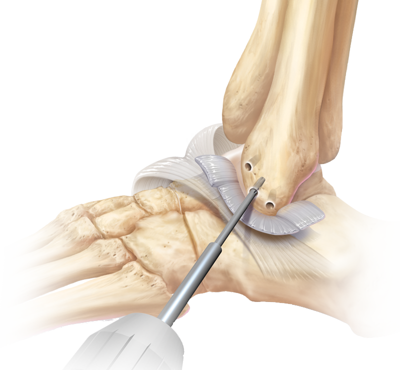 Ankle Ligament Surgery