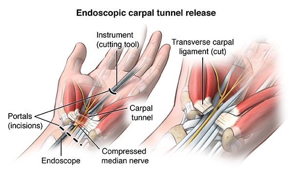 Carpal Tunnel Release