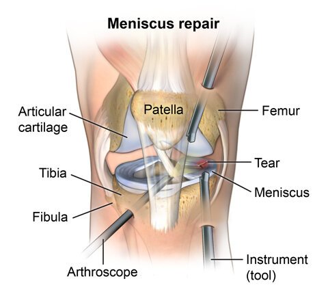 Knee Meniscus Surgery