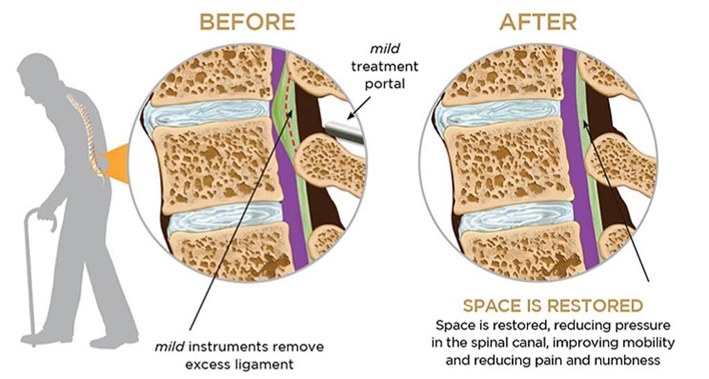 MILD Procedure