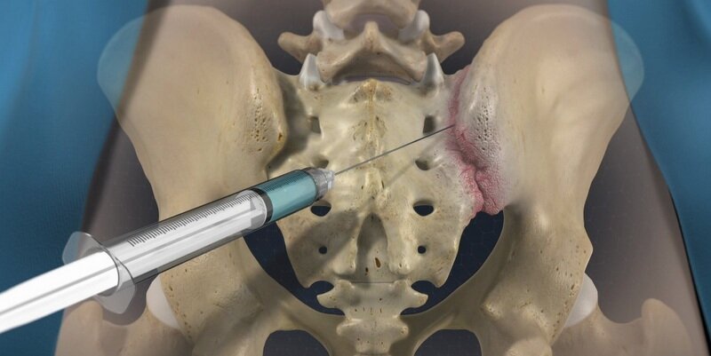 SI Joint Injection